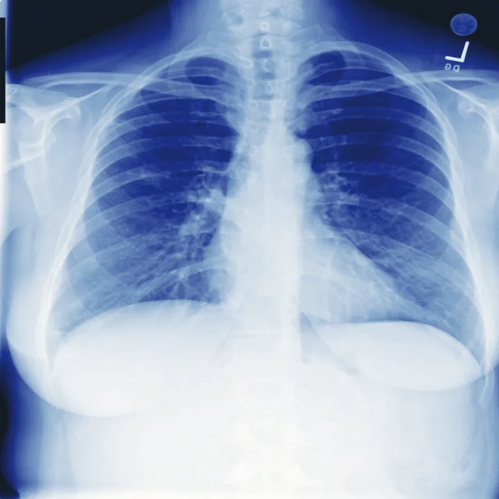 A chest radiograph in indigo duotone