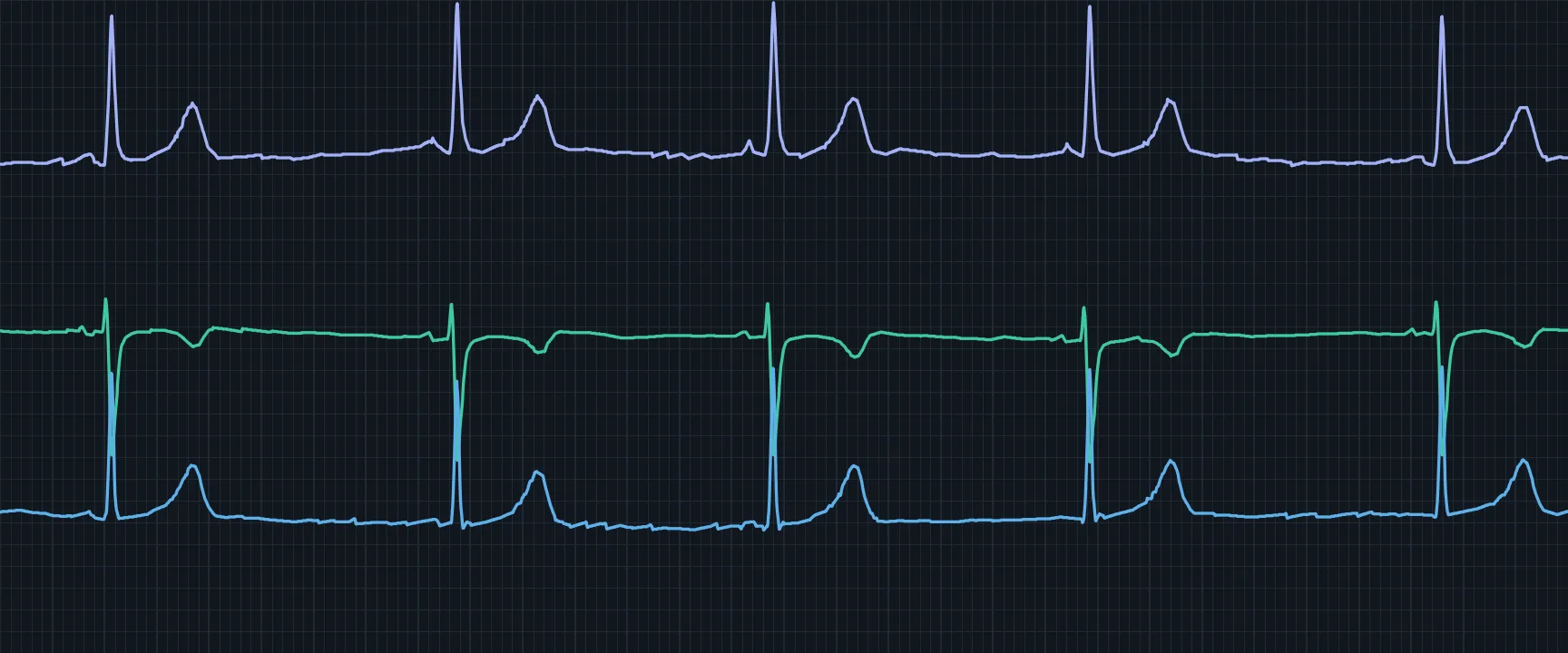 Three ECG traces on chart-paper grid