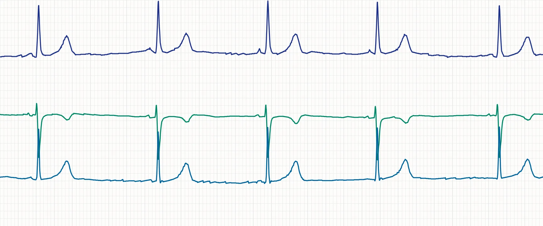 Three ECG traces on chart-paper grid